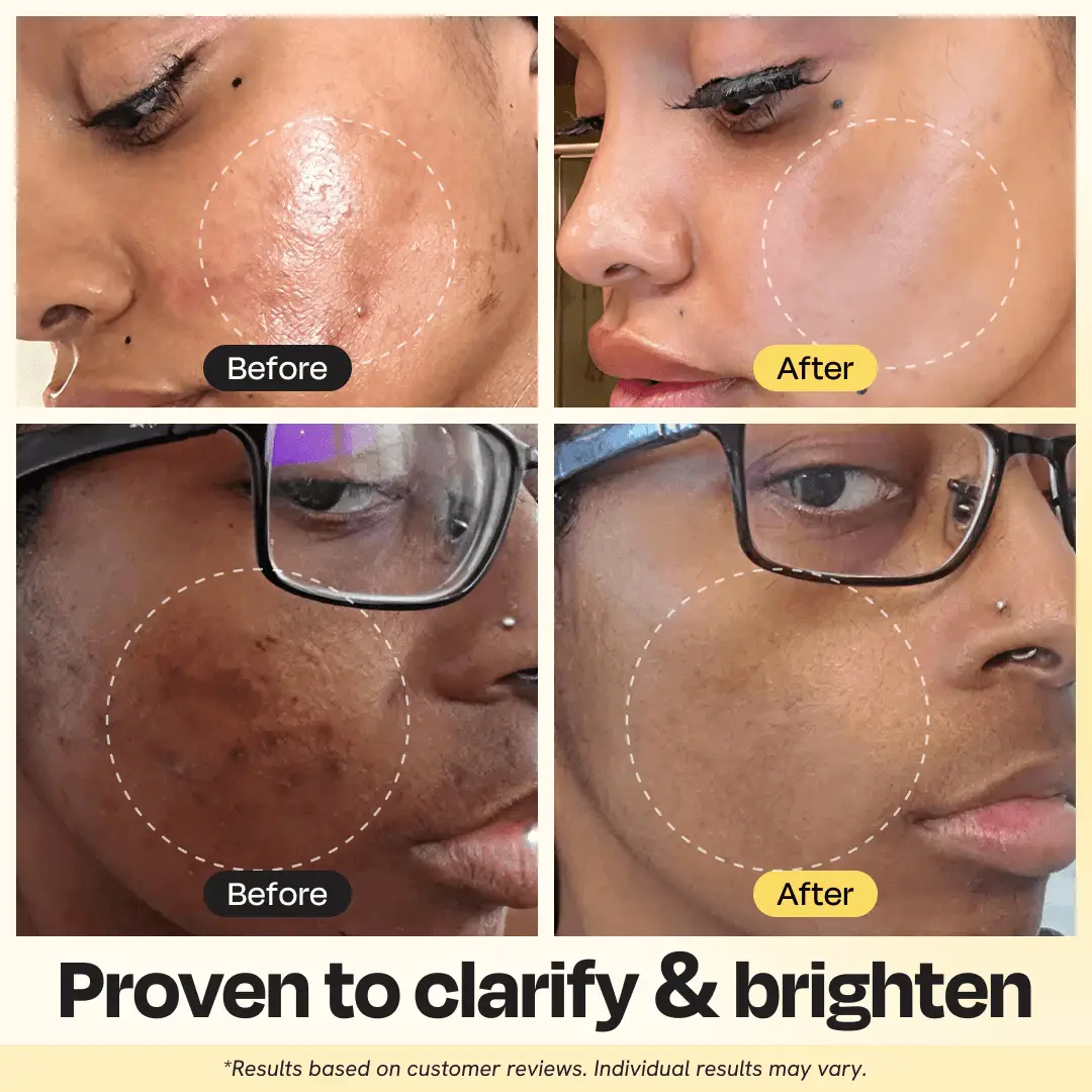 Gleamin Vitamin C Clay Mask, face mask; before and after collage of two users showing clearer, brighter skin.