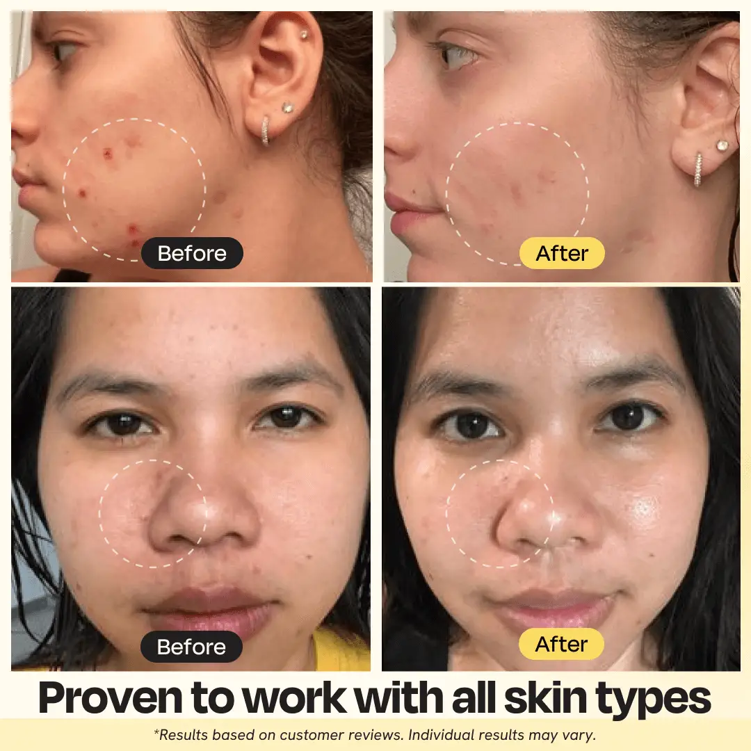 Gleamin Vitamin C Clay Mask; 4-image collage showing before/after pore clearing and brightness.